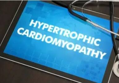 Aficamten Beats Metoprolol in Obstructive HCM, Strengthening Case Ahead of FDA Decision Aficamten Beats Metoprolol in Obstructive HCM, Strengthening Case Ahead of FDA Decision